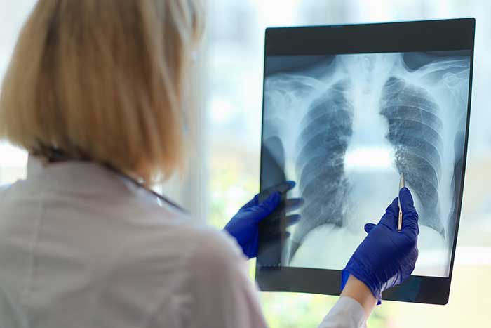 doctor examining lung x-ray